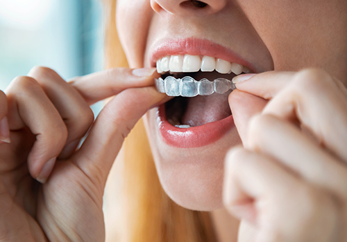 Invisalign, traitement avec des aligneurs invisibles