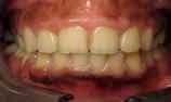 Traitement d'orthodontie des enfants: résultat final. Le sourire éternel