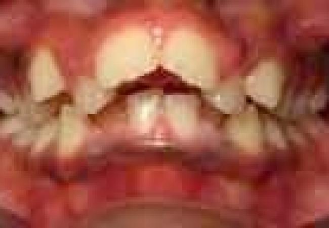 Traitement orthodontique des enfants