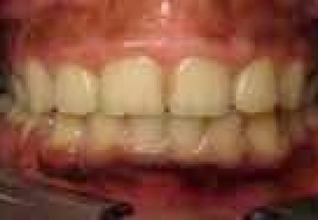 Traitement d'orthodontie des enfants: résultat final. Le sourire éternel