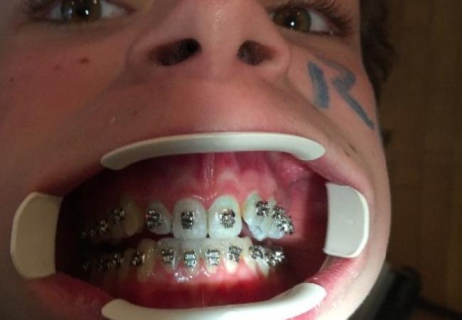 Brackets et dents. Collage en orthodontie utilisé par Mr. Baeten à Watermael-Boitsfort